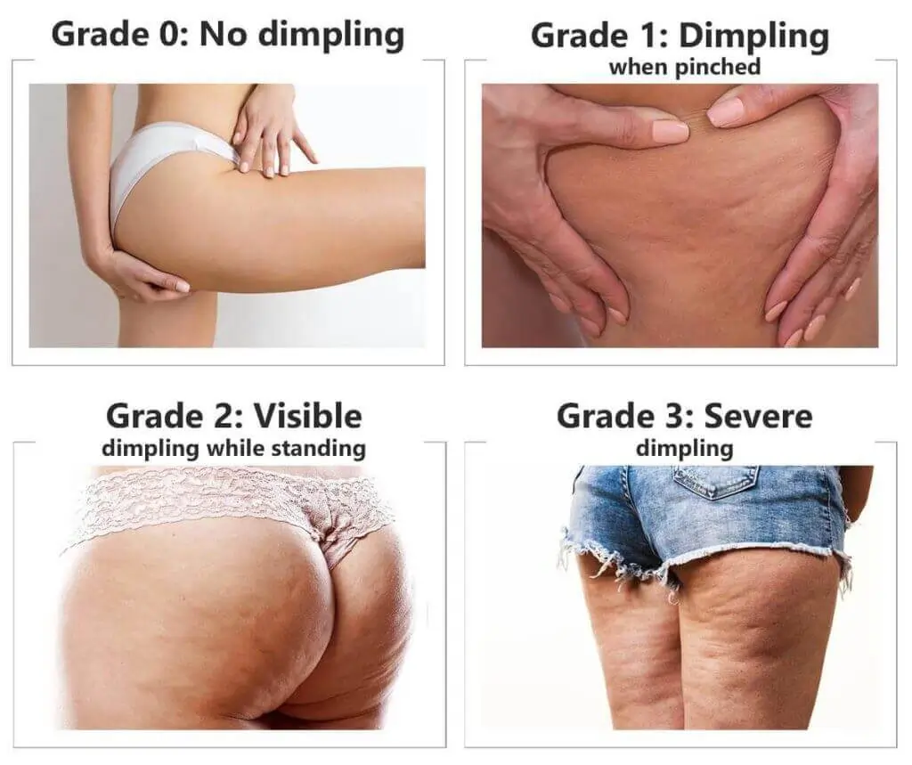 Representation of the stages of cellulite development Billingshurst